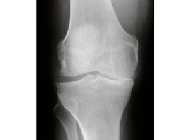 Diagnosis of knee arthrosis joint