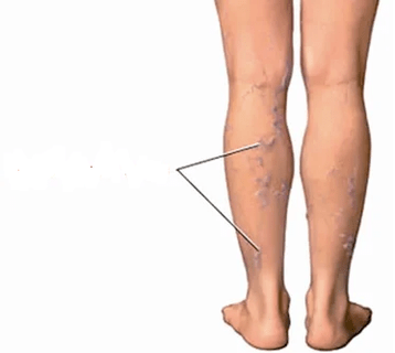 The effects of knee arthrosis