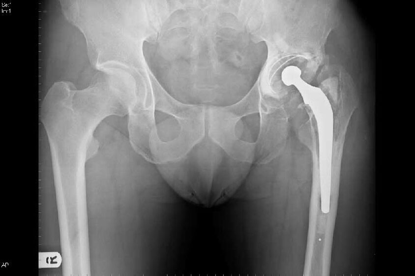 Coxarthrosis