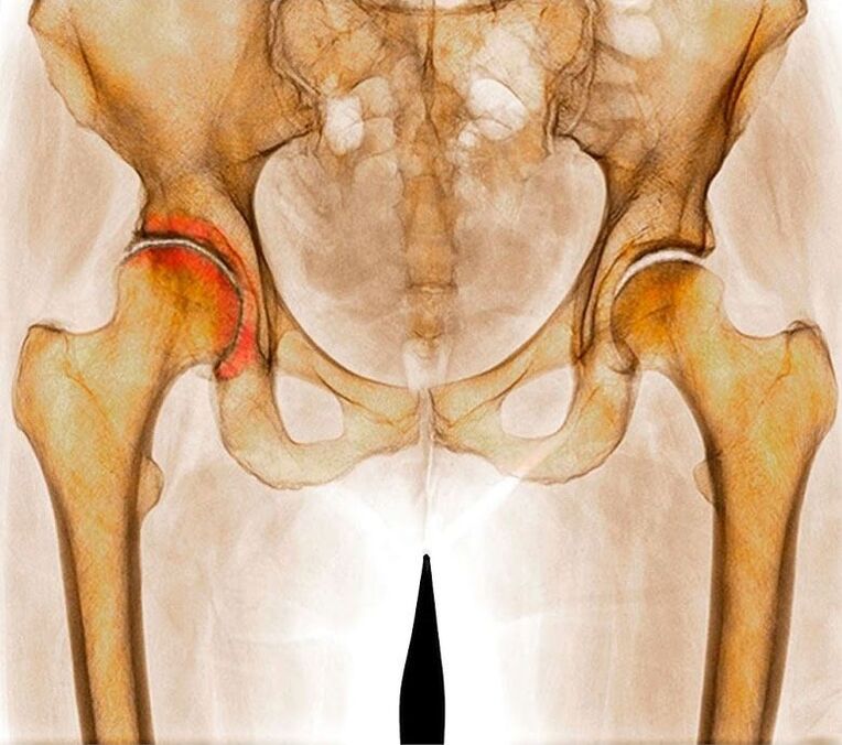 Hip arthrosis