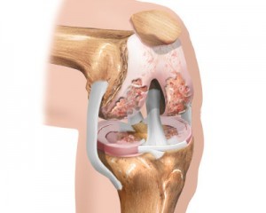 initial stage of osteoarthritis of the knee