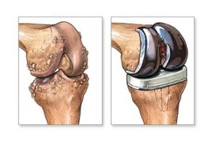 knee replacement in osteoarthritis