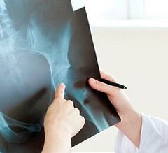 How to treat arthrosis of the hip joint