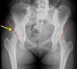 Methods for treating arthrosis of the hip joint