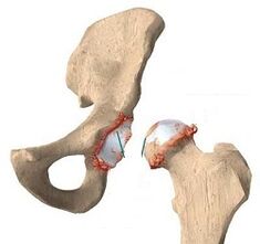 The causes of the development of arthrosis of the hip joint