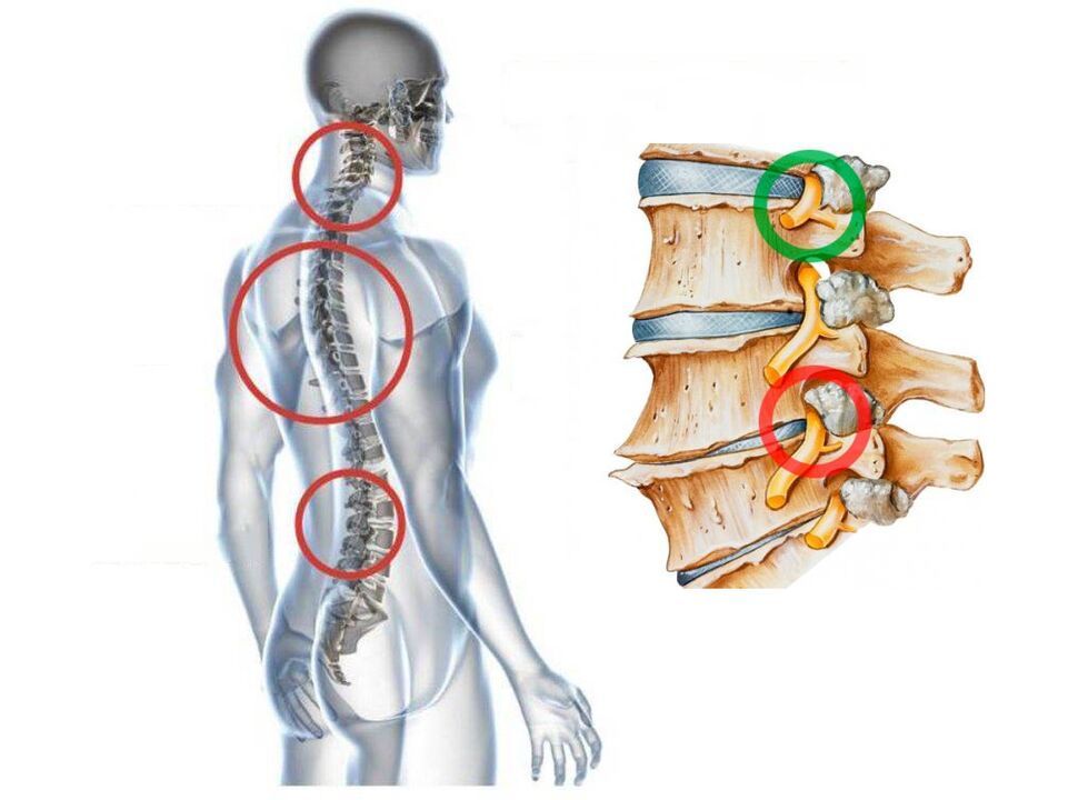 What does cervical osteochondrosis look like to the vertebrae