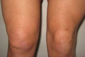Inflammation in the knee joint with arthritis and arthrosis