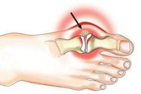 joint damage due to arthritis and arthrosis