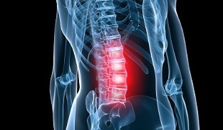 the second stage of development of lumbar osteochondrosis
