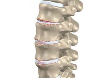 development of spinal osteochondrosis