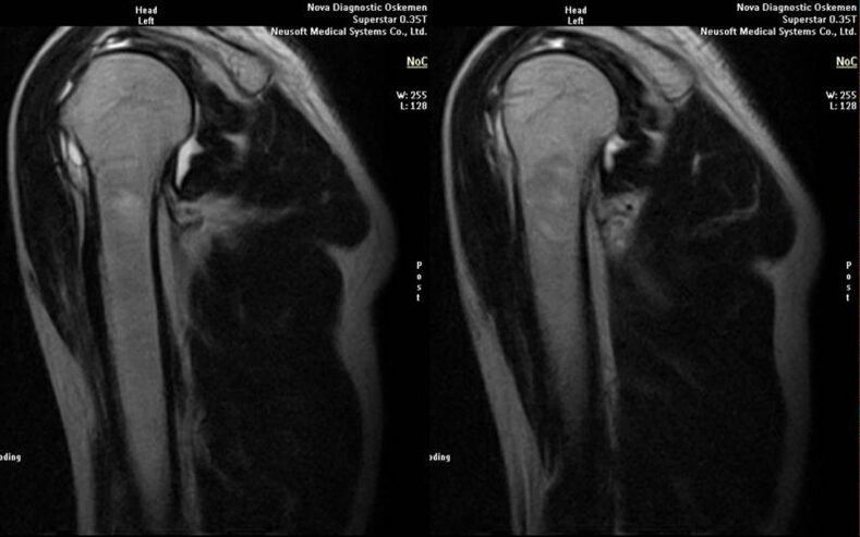 arthrosis of the shoulder joint on an X-ray