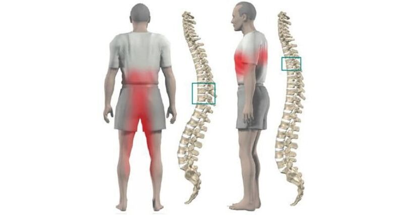 pain in the body and spine with osteochondrosis