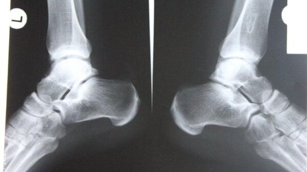 Diagnosis of ankle arthrosis by radiography