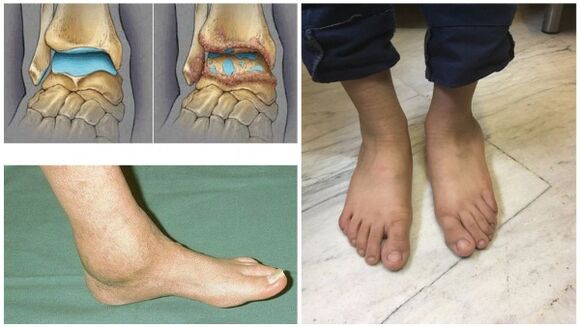 Swelling and deformation of the ankle joint due to osteoarthritis