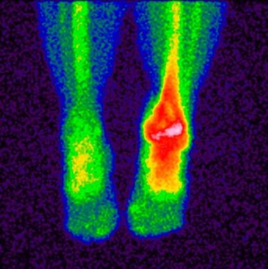 The method of differential diagnosis of cruciarthrosis is scintigraphy